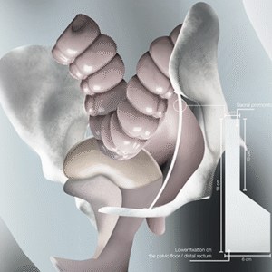 ایمپلنت بیولوژیک کلاژنی شرکت مادزیست فن آور بین الملل